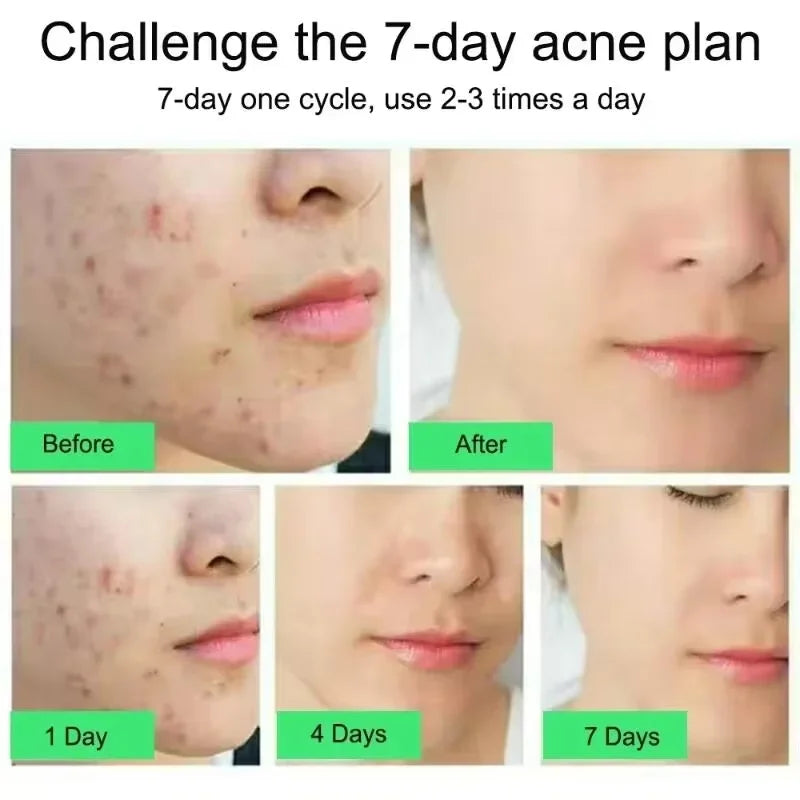 Salicylic Acid Acne Treatment Cream - Pimple Spot Repair, Pore Cleansing & Oil Control Skincare