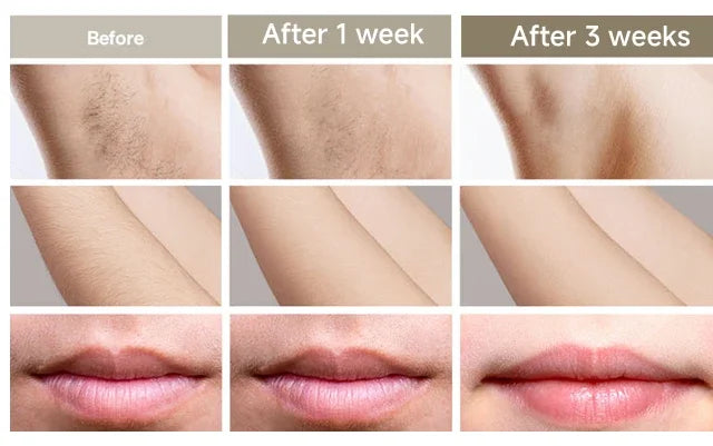 Body Bikini IPL Hair Removal Device – 999,999 Flashes, Permanent Painless Laser Epilator for Women, Home Use