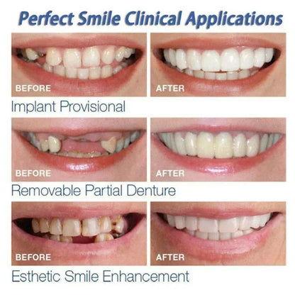 Veneer Snap-on Teeth Kit – Fake Temporary Tooth Whitening Replacement, Dental Fix for Men & Women