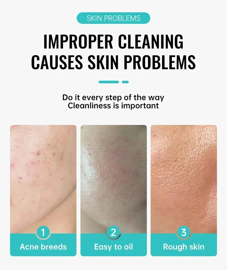 Effective Acne Removal Cream – Anti-Acne Gel for Redness, Pimples, Deep Pore Cleaning & Oil Control Skin Care