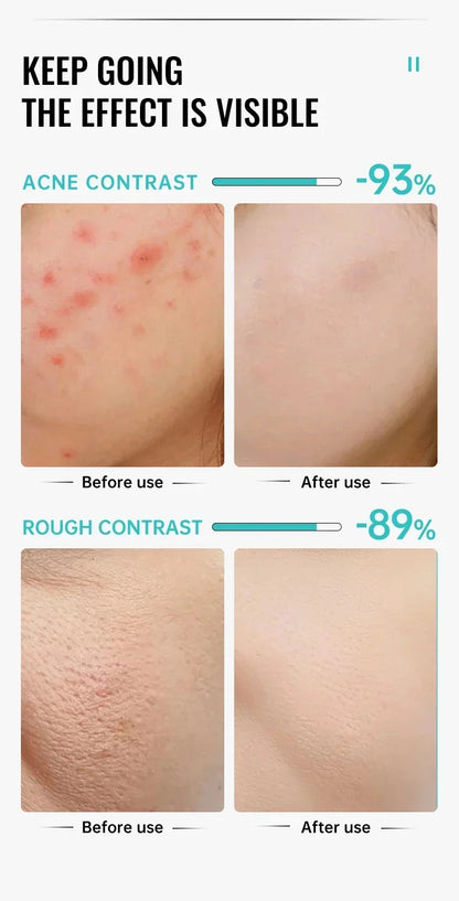 Salicylic Acid Acne Removal Cream – Anti-Acne, Redness Repair, Deep Cleaning & Oil Control Skincare