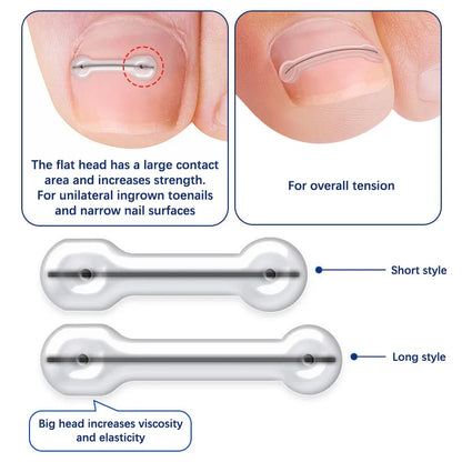 2-Piece Ingrown Toenail Correction Kit – Elastic Patch & Straightening Clip Pedicure Tool for Toe Nail Treatment