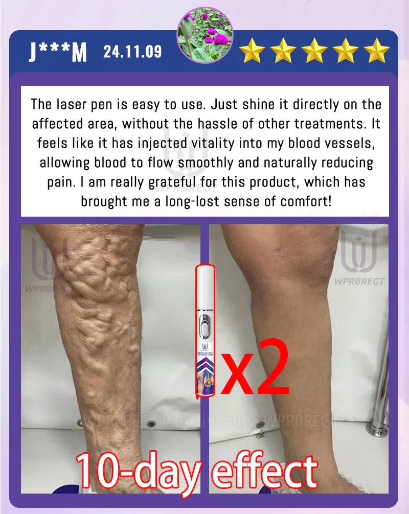 2nd Gen Varicose Vein Laser Therapy Device – Relieves Spider Leg Pain, Treats Vasculitis & Phlebitis