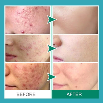 Effective Acne Removal Cream – Anti-Acne Gel for Redness, Pimples, Deep Pore Cleaning & Oil Control Skin Care