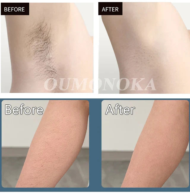 Body Bikini IPL Hair Removal Device – 999,999 Flashes, Permanent Painless Laser Epilator for Women, Home Use