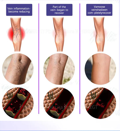 2nd Gen Varicose Vein Laser Therapy Device – Relieves Spider Leg Pain, Treats Vasculitis & Phlebitis