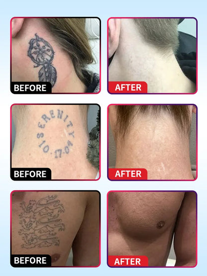 Quick Tattoo Removal Cream – Effective for Pigmented & Permanent Makeup Tattoo Removal