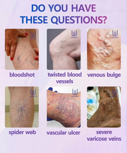 Varicose Vein & Spider Leg Pain Relief Treatment — Painless Care for Vasculitis & Phlebitis