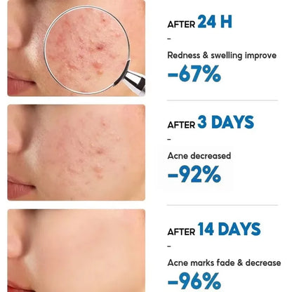 Effective Acne Removal Cream – Anti-Acne Gel for Redness, Pimples, Deep Pore Cleaning & Oil Control Skin Care