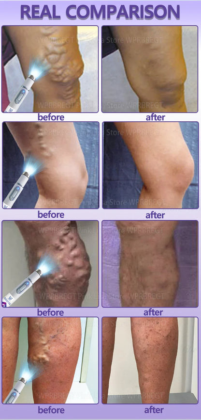 Varicose Vein & Spider Leg Pain Relief Treatment — Painless Care for Vasculitis & Phlebitis