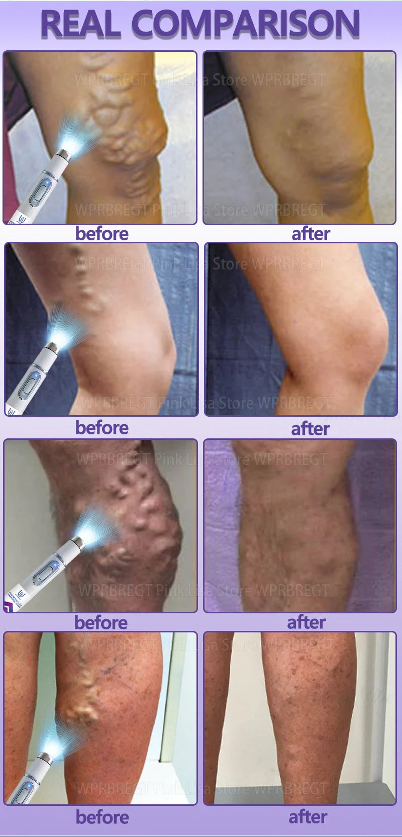 2nd Gen Varicose Vein Laser Therapy Device – Relieves Spider Leg Pain, Treats Vasculitis & Phlebitis