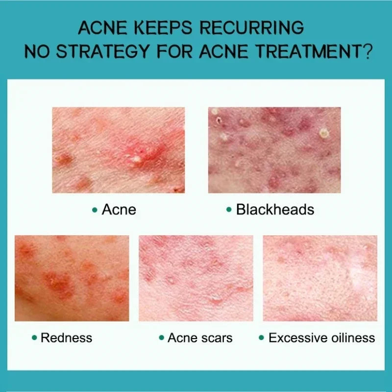 Effective Acne Removal Cream – Anti-Acne Gel for Redness, Pimples, Deep Pore Cleaning & Oil Control Skin Care
