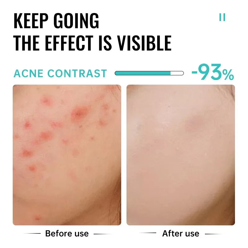 Salicylic Acid Acne Treatment Cream - Pimple Spot Repair, Pore Cleansing & Oil Control Skincare