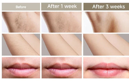Body Bikini IPL Hair Removal Device — 999,999 Flashes Permanent Painless Laser Epilator for Women, Home Use