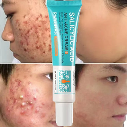Salicylic Acid Acne Treatment Cream - Pimple Spot Repair, Pore Cleansing & Oil Control Skincare