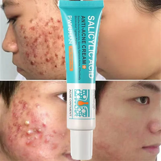Salicylic Acid Acne Treatment Cream - Pimple Spot Repair, Pore Cleansing & Oil Control Skincare