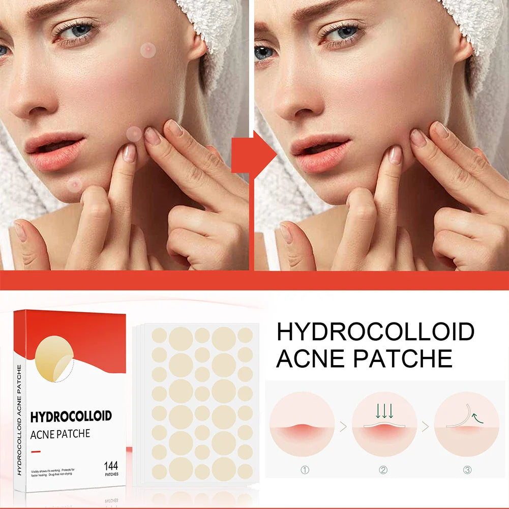 144pcs Face Acne Pimple Patch Set – 2 Sizes Invisible Professional Healing Spot Stickers for Men & Women Skin Care