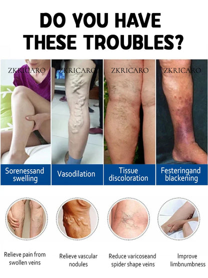 2nd Gen Varicose Vein Laser Therapy Device – Relieves Spider Leg Pain, Treats Vasculitis & Phlebitis
