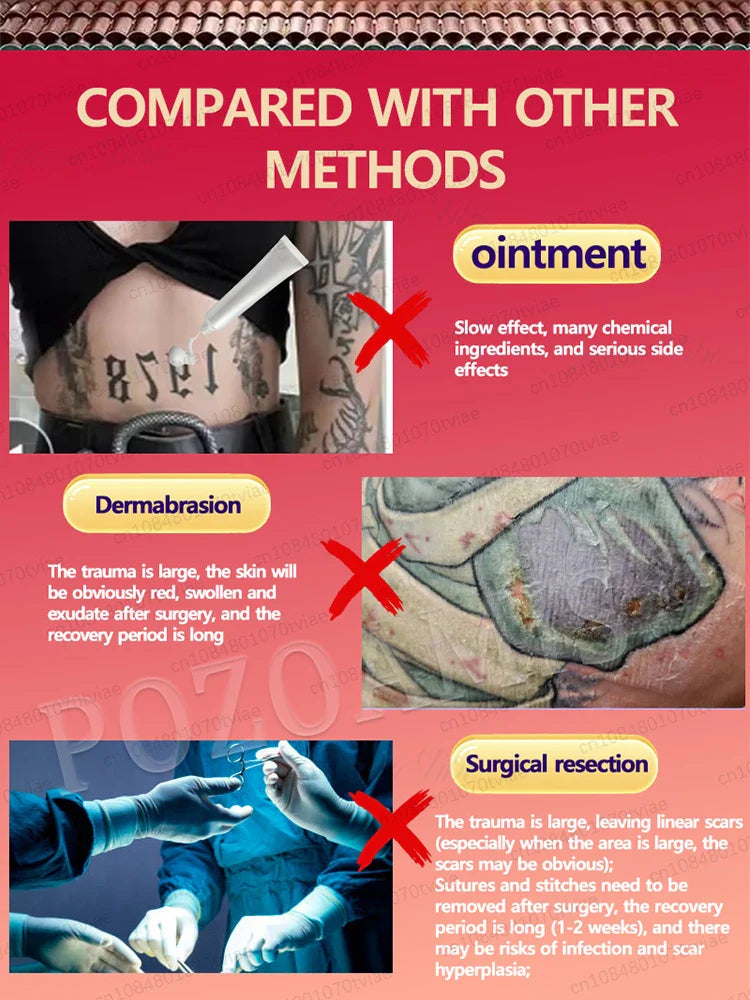 Blue Light Tattoo Removal Pen – Unisex, Suitable for All Ages, Free Shipping