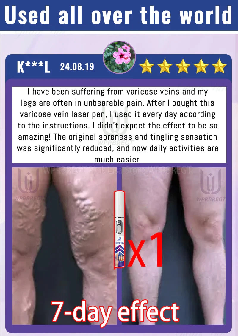 Varicose Vein & Spider Leg Pain Relief Treatment — Painless Care for Vasculitis & Phlebitis